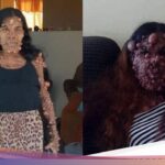 Kondisi Terkini Wanita Idap Ribuan Tumor di Sekujur Tubuh usai Jalani Operasi health