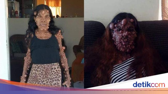 Kondisi Terkini Wanita Idap Ribuan Tumor di Sekujur Tubuh usai Jalani Operasi health