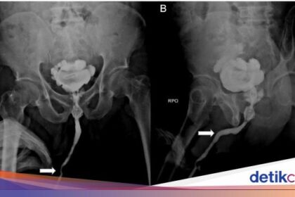 Media Asing Beritakan Pria Kaltim Masukkan Kabel ke Mr P, Berujung Gagal Ginjal health